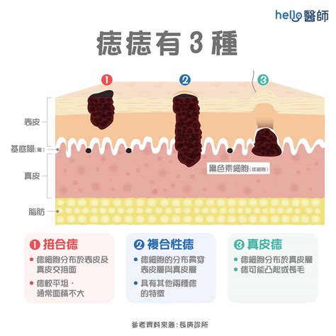 全身長毛|痣形成的原因？痣長毛、痣變多變大是痣病變？5招判別